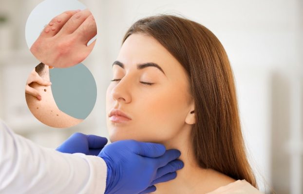 What Are Moles, Warts, and Sebaceous Cysts? | Treatment Methods and Laser Applications
