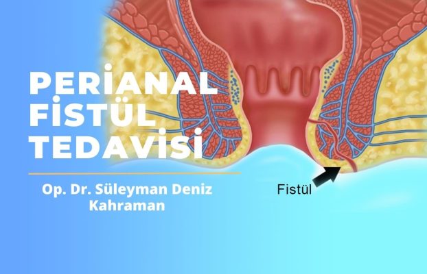 What Is a Perianal Fistula? Symptoms and Effective Treatment Methods