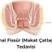 anal fissur makat catlagi tedavisi